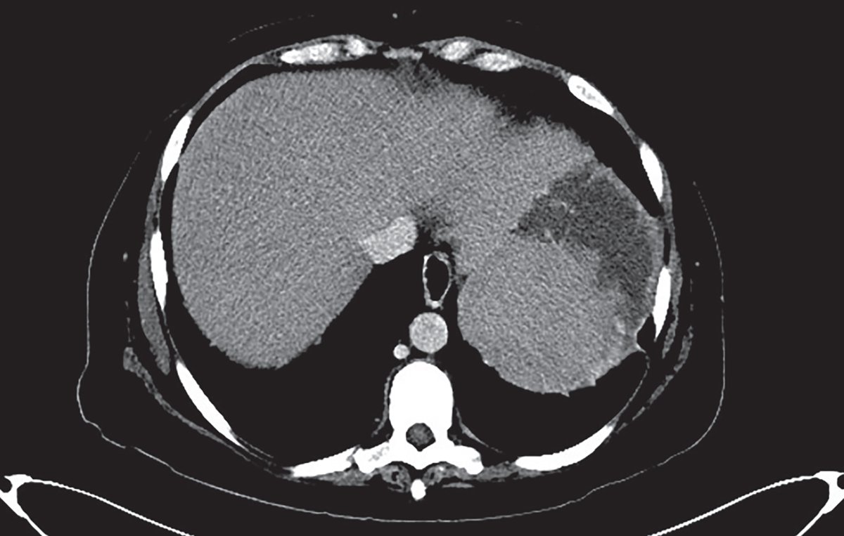 NEJM Evidence (@nejmevidence) on Twitter photo A 47-year-old woman presented for evaluation of pain in the left shoulder, fevers, and malaise. How do you begin the approach to evaluating this patient? Learn more in a new Morning Report: eviden.cc/44I2JpY
<a href="/ClementLeeMD/">Clement Lee, MD, MSc</a> <a href="/justincheungmd/">Justin Cheung, MD</a> #MedEd A 47-year-old woman presented for evaluation of pain in the left shoulder, fevers, and malaise. How do you begin the approach to evaluating this patient? Learn more in a new Morning Report: eviden.cc/44I2JpY
<a href="/ClementLeeMD/">Clement Lee, MD, MSc</a> <a href="/justincheungmd/">Justin Cheung, MD</a> #MedEd