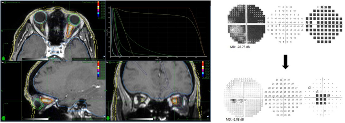 ASTRO (@astro_org) on Twitter photo Read this new #RedJournal article from <a href="/NeuroBesta/">Istituto Neurologico Carlo Besta</a> on hypofractionated radiosurgery, 25 Gy in 5 fractions, for optic nerve sheath meningiomas. #radonc tinyurl.com/marchettired Read this new #RedJournal article from <a href="/NeuroBesta/">Istituto Neurologico Carlo Besta</a> on hypofractionated radiosurgery, 25 Gy in 5 fractions, for optic nerve sheath meningiomas. #radonc tinyurl.com/marchettired