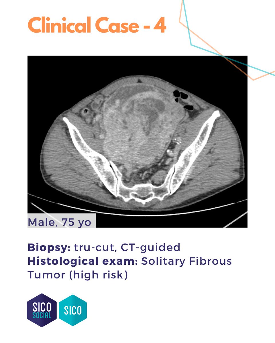 oncoteamsarcoma's tweet image. ‼️ Pelvic Sarcoma
A Solitary Fibrous Tumor managed at the Sarcoma Surgery Unit, @HumanitasMilano (Dir. @FCMCananzi ).
#SarcomaSurgery #Teamwork #SICOSarcomaSocial #SurgicalOncology #RareTumors