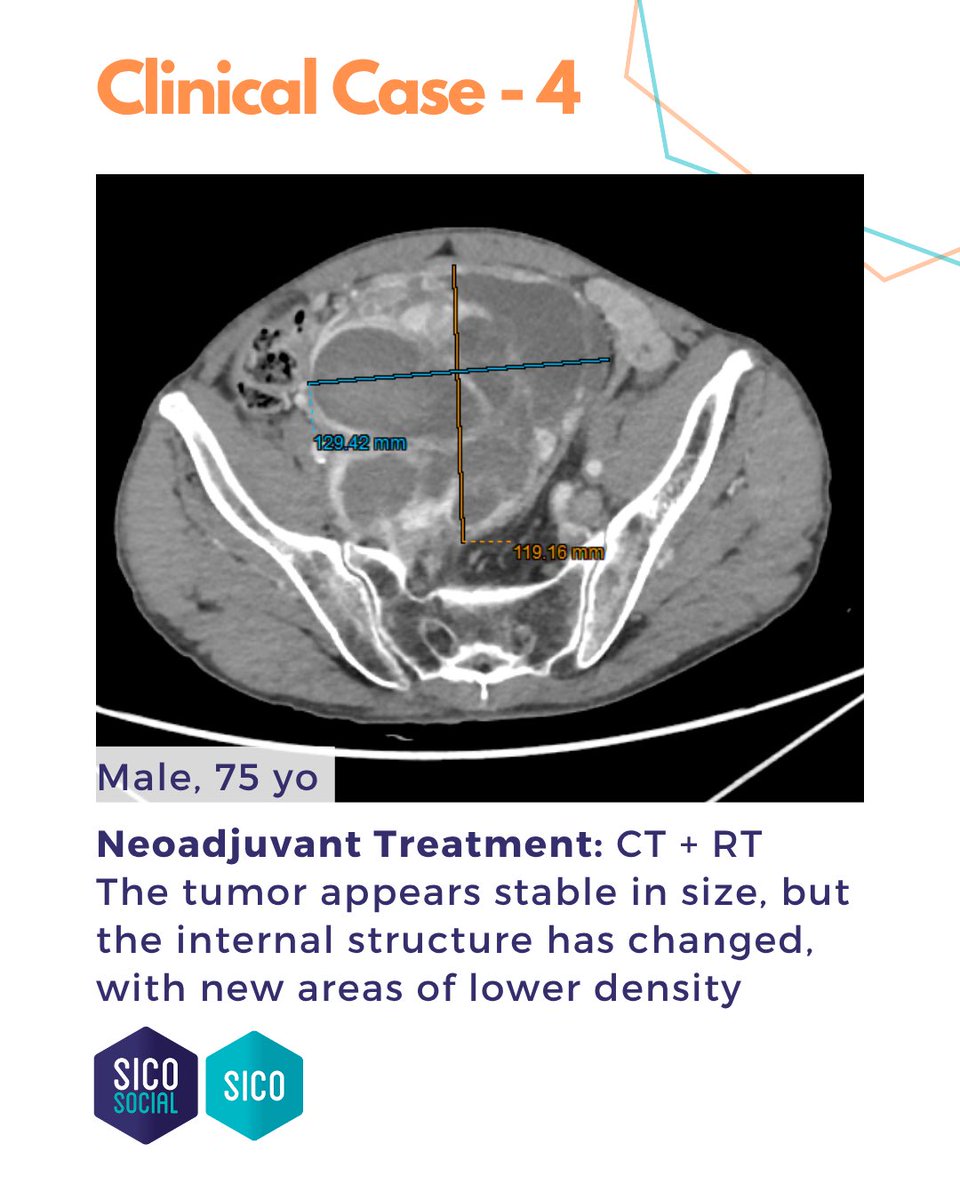 oncoteamsarcoma's tweet image. ‼️ Pelvic Sarcoma
A Solitary Fibrous Tumor managed at the Sarcoma Surgery Unit, @HumanitasMilano (Dir. @FCMCananzi ).
#SarcomaSurgery #Teamwork #SICOSarcomaSocial #SurgicalOncology #RareTumors