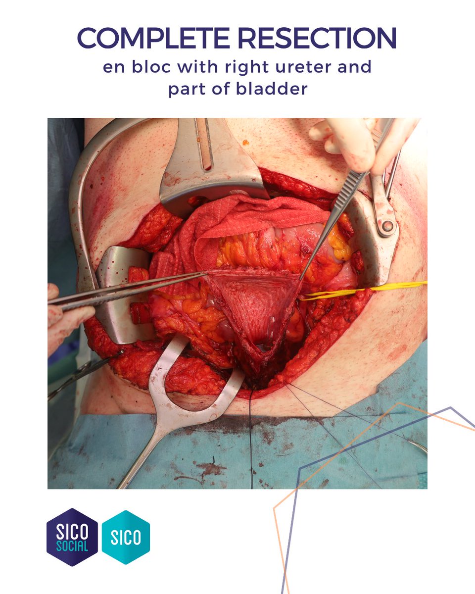 oncoteamsarcoma's tweet image. ‼️ Pelvic Sarcoma
A Solitary Fibrous Tumor managed at the Sarcoma Surgery Unit, @HumanitasMilano (Dir. @FCMCananzi ).
#SarcomaSurgery #Teamwork #SICOSarcomaSocial #SurgicalOncology #RareTumors