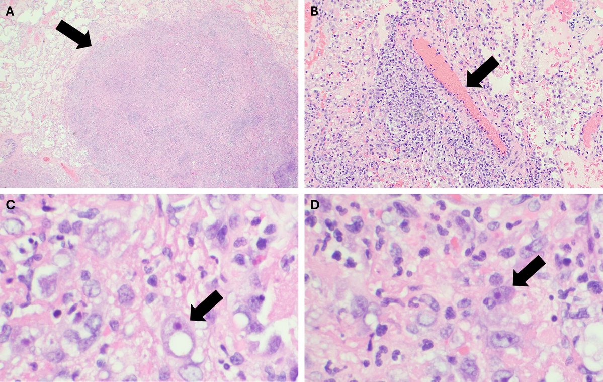 ASMCaseReports (@asmcasereports) on Twitter photo A team from <a href="/UAZMedTucson/">UA College of Medicine – Tucson</a> describe a rare case of pulmonary infection due to Balamuthia mandrillaris in Arizona (US), showcasing that not all miliary disease is tuberculosis & coccidioidomycosis | #ASMCaseReports <a href="/UAZMedTucson/">UA College of Medicine – Tucson</a>
journals.asm.org/doi/10.1128/as… A team from <a href="/UAZMedTucson/">UA College of Medicine – Tucson</a> describe a rare case of pulmonary infection due to Balamuthia mandrillaris in Arizona (US), showcasing that not all miliary disease is tuberculosis & coccidioidomycosis | #ASMCaseReports <a href="/UAZMedTucson/">UA College of Medicine – Tucson</a>
journals.asm.org/doi/10.1128/as…