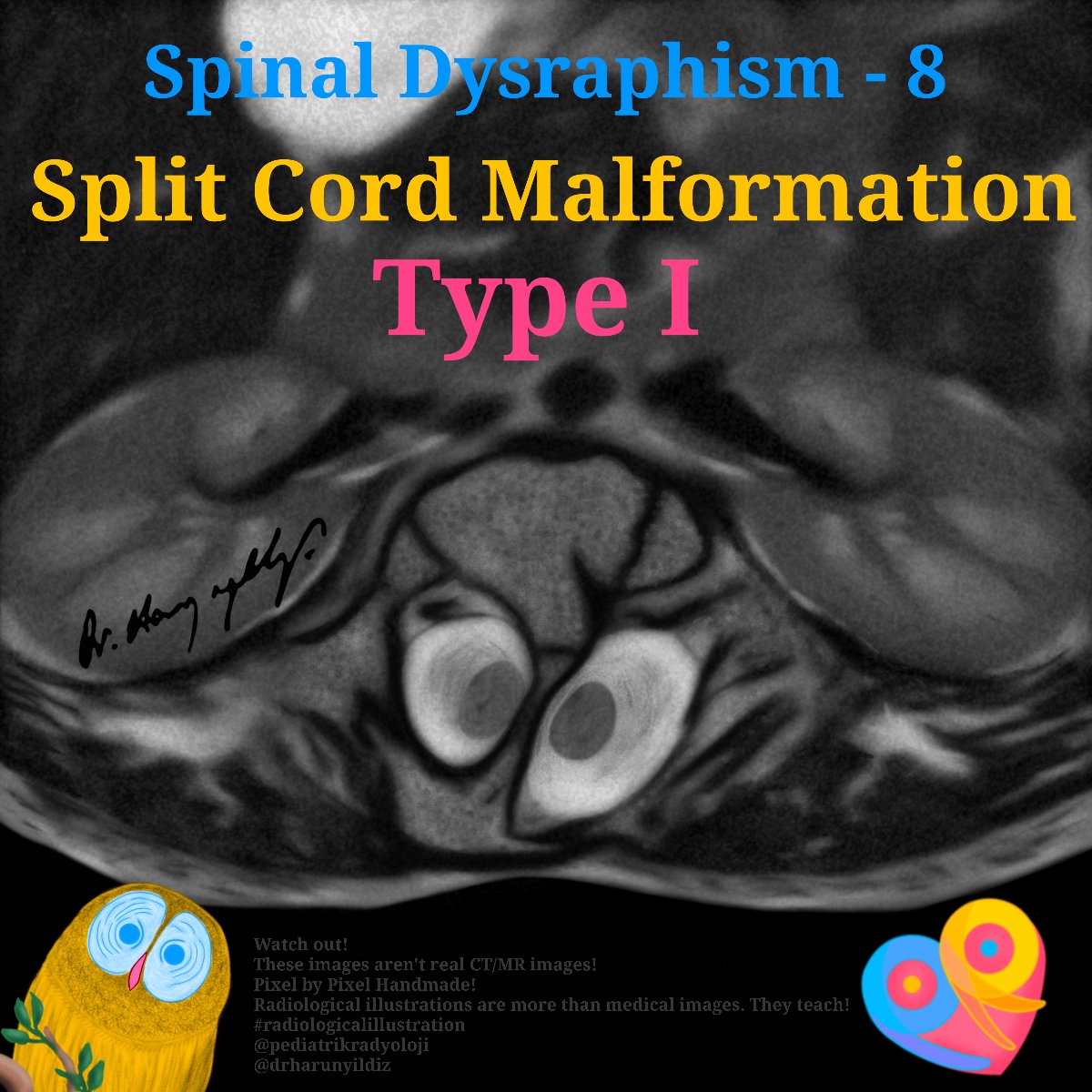 drharunyildiz's tweet image. Hemimyelomeningocele
doi.org/10.1007/s00247…
doi.org/10.4103/1817-1…
#radiologicalillustration ✍️
pixel by pixel handmade!