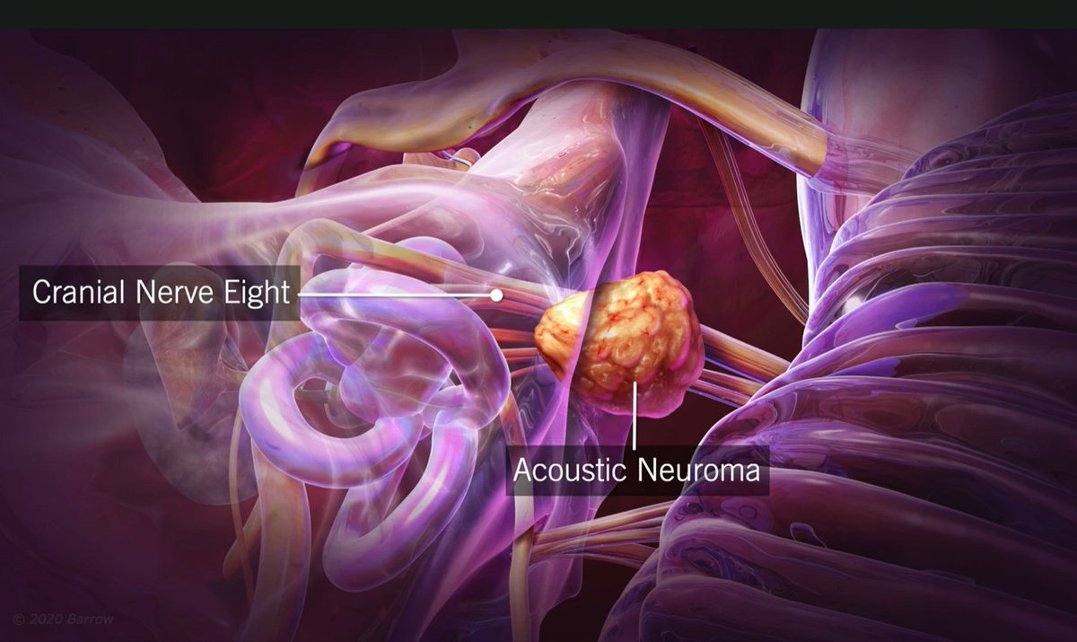 It's #ANAWareness Week. An #acousticneuroma is a noncancerous tumor that develops on the nerve that carries sound &amp; balance info from the inner ear to the brain. Barrow offers a team-based &amp; patient-centered approach for managing these tumors. Learn more: BarrowNeuro.org/AcousticNeuroma
