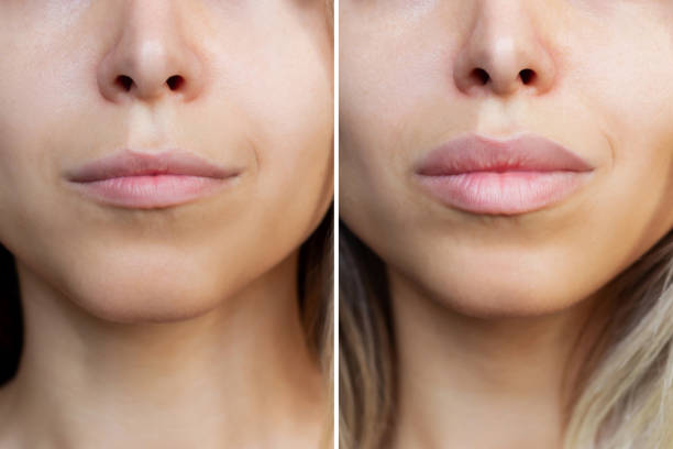 HairAdvance's tweet photo. Want fuller, more defined lips? 💋

Dr. Vance Elliott offers expert lip augmentation for natural, balanced results—personalized just for you.

Pucker up with confidence 👉 https://t.co/uTcjQCj6gc https://t.co/1alX5BoxLG