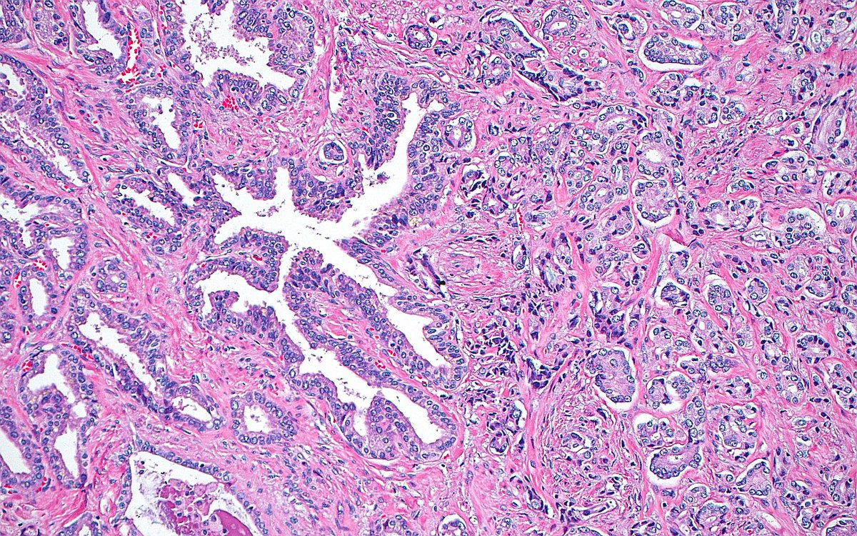 🔬 Seminal Vesicle Invasion ~ Prostate cancer glands (right half of image) and benign seminal vesicle epithelium (left half of image) ~ #GUpath #Pathology #Prostate