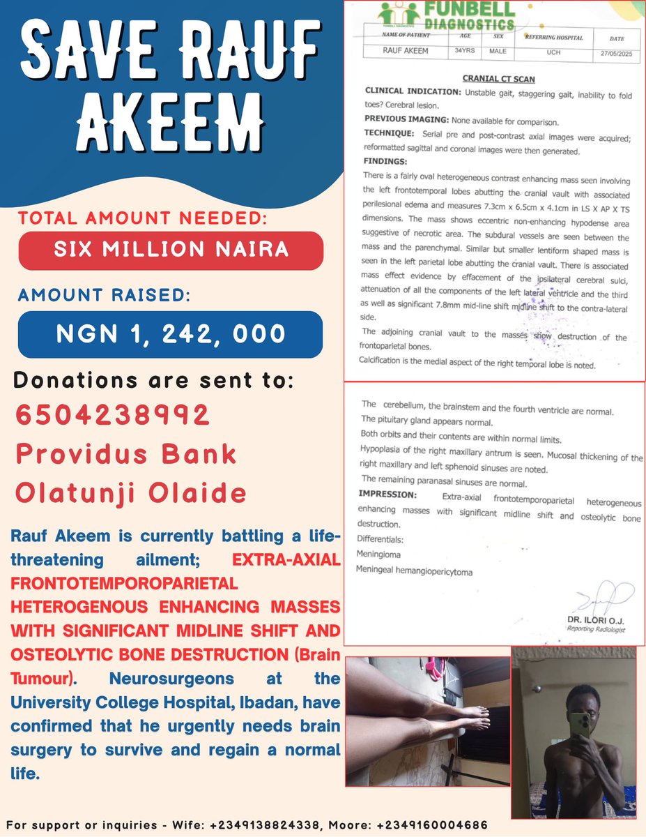 SaveAkeemRauf's tweet photo. 🚨 URGENT: Save Rauf Akeem!

A 7.3cm brain tumor is slowly killing him.

👉🏾 He needs ₦6M for life-saving surgery @ UCH Ibadan
✅ ₦1.2M raised! Pls help close the gap!

🙏🏾 PLS DONATE
- Providus Bank
- 6504238992  (Olatunji Olaide)

📞 Verify: 
+2349138824338 (Wife) https://t.co/XKgEK1B7Pd