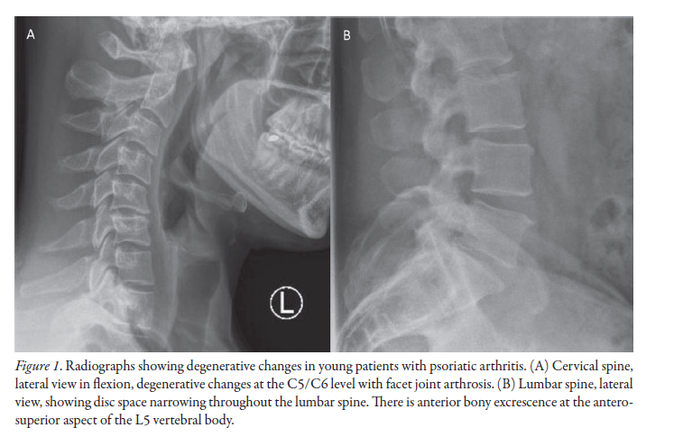 The Journal of Rheumatology (@jrheum) on Twitter photo Research Article
Degenerative Disc Disease in Young Adults With Psoriatic Arthritis
📖 jrheum.org/cgi/content/fu…
<a href="/SchroederInst/">Schroeder Arthritis Institute</a> <a href="/KBI_UHN/">Krembil Brain Institute</a> <a href="/UofTRheum/">UofT Rheumatology</a>
#degenerativediscdisease #psoriaticarthritis Research Article
Degenerative Disc Disease in Young Adults With Psoriatic Arthritis
📖 jrheum.org/cgi/content/fu…
<a href="/SchroederInst/">Schroeder Arthritis Institute</a> <a href="/KBI_UHN/">Krembil Brain Institute</a> <a href="/UofTRheum/">UofT Rheumatology</a>
#degenerativediscdisease #psoriaticarthritis