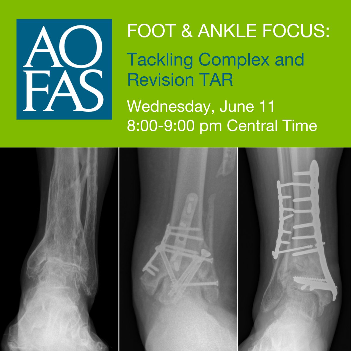 AOFAS (@aofas) on Twitter photo Webinar Tomorrow! Don't miss our expert panel as they discuss total ankle arthroplasty, review current evidence and identify best-practice techniques to help surgeons make the best decisions and optimize patient outcomes.
Learn more and register today: aofas.org/focus Webinar Tomorrow! Don't miss our expert panel as they discuss total ankle arthroplasty, review current evidence and identify best-practice techniques to help surgeons make the best decisions and optimize patient outcomes.
Learn more and register today: aofas.org/focus