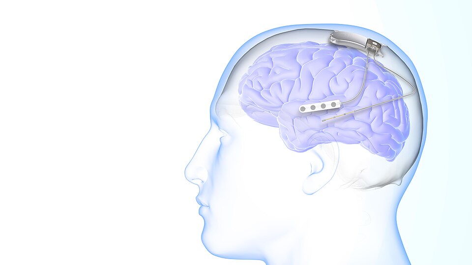 ⚡️In 2013, the FDA approved NeuroPace RNS®—a breakthrough NINDS-backed device that helps reduce seizures in adults with drug-resistant epilepsy. Follow <a href="/NIH_NINDS/">NINDS</a> and us to learn more! #NINDS75 #ABrainCoProud