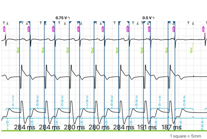 I love doing V-A conduction testing while I'm doing RV thresholds. Not sure why the last 2 beats retrograde conduction got shorter but still. It's a little secret cool thing I like to do 😊 #EPEEPS #CIEDthings