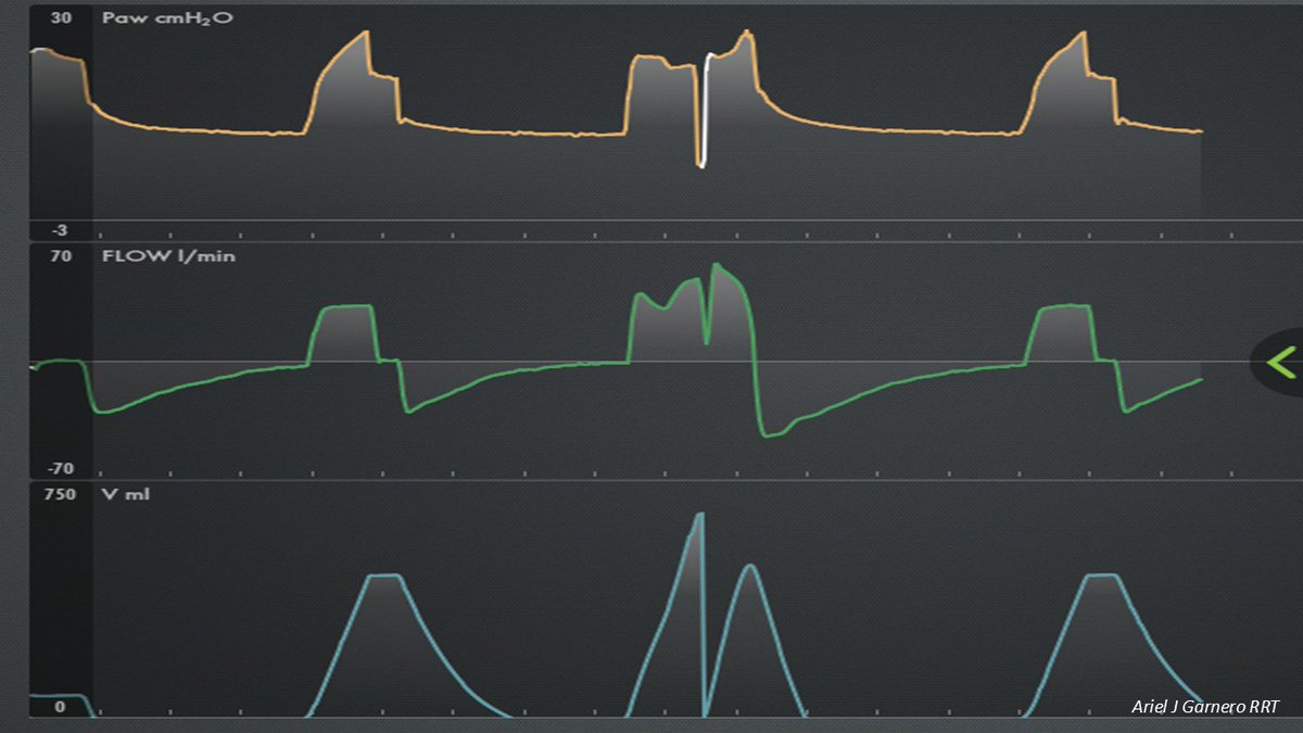 Ariel J Garnero (@arielg_rrt) on Twitter photo This is a tough challenge for the brave ones who like ventilatory modes: What mode is it? <a href="/DocMusician/">Doc Musician</a> <a href="/DrMiguelIbarra1/">Dr. Miguel Ibarra-Estrada</a> <a href="/emireles_c/">Eduardo Mireles-Cabodevila</a> <a href="/CCF_PCCM/">CCF Pulmonary and Critical Care Fellows</a> <a href="/critconcepts/">Critical Concepts</a> <a href="/IM_Crit_/">IMCrit</a> <a href="/MegriMohammed/">Mohammed Megri. MD</a> <a href="/OfVentilation/">Society of Mechanical Ventilation</a> <a href="/Vent_Busters/">VentBusters</a> <a href="/ATC_Ventilator/">Ben Fabry</a> <a href="/CCF_PCCM/">CCF Pulmonary and Critical Care Fellows</a> <a href="/SaudiRTs/">Saudi Respiratory</a> <a href="/RespiratorySCCM/">SCCM Respiratory Care Section</a> This is a tough challenge for the brave ones who like ventilatory modes: What mode is it? <a href="/DocMusician/">Doc Musician</a> <a href="/DrMiguelIbarra1/">Dr. Miguel Ibarra-Estrada</a> <a href="/emireles_c/">Eduardo Mireles-Cabodevila</a> <a href="/CCF_PCCM/">CCF Pulmonary and Critical Care Fellows</a> <a href="/critconcepts/">Critical Concepts</a> <a href="/IM_Crit_/">IMCrit</a> <a href="/MegriMohammed/">Mohammed Megri. MD</a> <a href="/OfVentilation/">Society of Mechanical Ventilation</a> <a href="/Vent_Busters/">VentBusters</a> <a href="/ATC_Ventilator/">Ben Fabry</a> <a href="/CCF_PCCM/">CCF Pulmonary and Critical Care Fellows</a> <a href="/SaudiRTs/">Saudi Respiratory</a> <a href="/RespiratorySCCM/">SCCM Respiratory Care Section</a>