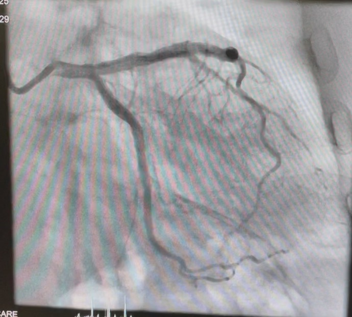 Elixir Medical Corp (@elixirmed) on Twitter photo LithiX Hertz Contact Intravascular Lithotripsy (HC-IVL) enters clinical practice for the first time in the UK
Prof. <a href="/MohanedEgred/">Mohaned Egred</a> from Freeman hospital in the UK performed a successful LithiX intervention on a patient with severe coronary calcification in multiple lesions with LithiX Hertz Contact Intravascular Lithotripsy (HC-IVL) enters clinical practice for the first time in the UK
Prof. <a href="/MohanedEgred/">Mohaned Egred</a> from Freeman hospital in the UK performed a successful LithiX intervention on a patient with severe coronary calcification in multiple lesions with