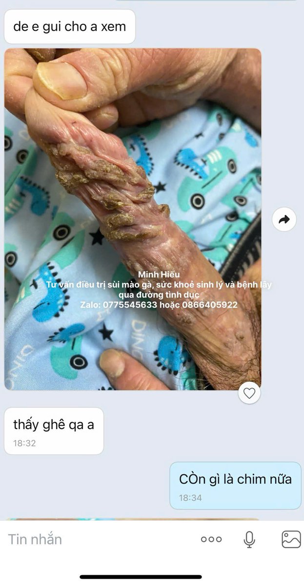 Bây giờ mới chia sẻ cho mọi người thấy. Một trường hợp bị HIV+SÙI MÀO GÀ. Mà bạn này lại tự ý bỏ ARV 3 năm nay. Mình đã khuyên dùng lại và bạn ấy đã bắt đầu sử dụng lại ARV được 2 ngày+điều trị Sùi
Cần hỗ trợ liên hệ
Zalo: 0775545633 hoặc 0866405922