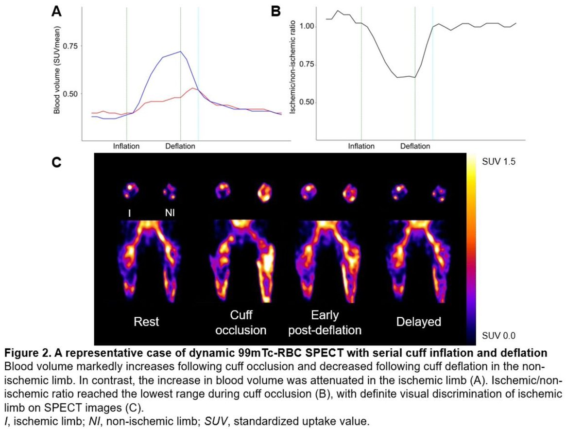 Excited to see our work developing a new dynamic translational nuclear model using Tc-labeled RBCs to estimate flow in PAD now in <a href="/JournalofNucMed/">JNM</a>! 

Led by Dr. Sang-Geon will be presented at SNMMI session later this month. Great work from the YTRIC team!!