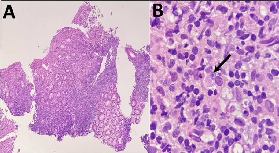 🔬 New case report: Rectal malakoplakia identified incidentally in a Crohns patient highlights diagnostic challenges in IBD pathology. This rare finding reminds us to maintain a high index of suspicion and consider malakoplakia in atypical presentations. #PathTwitter #GIpath