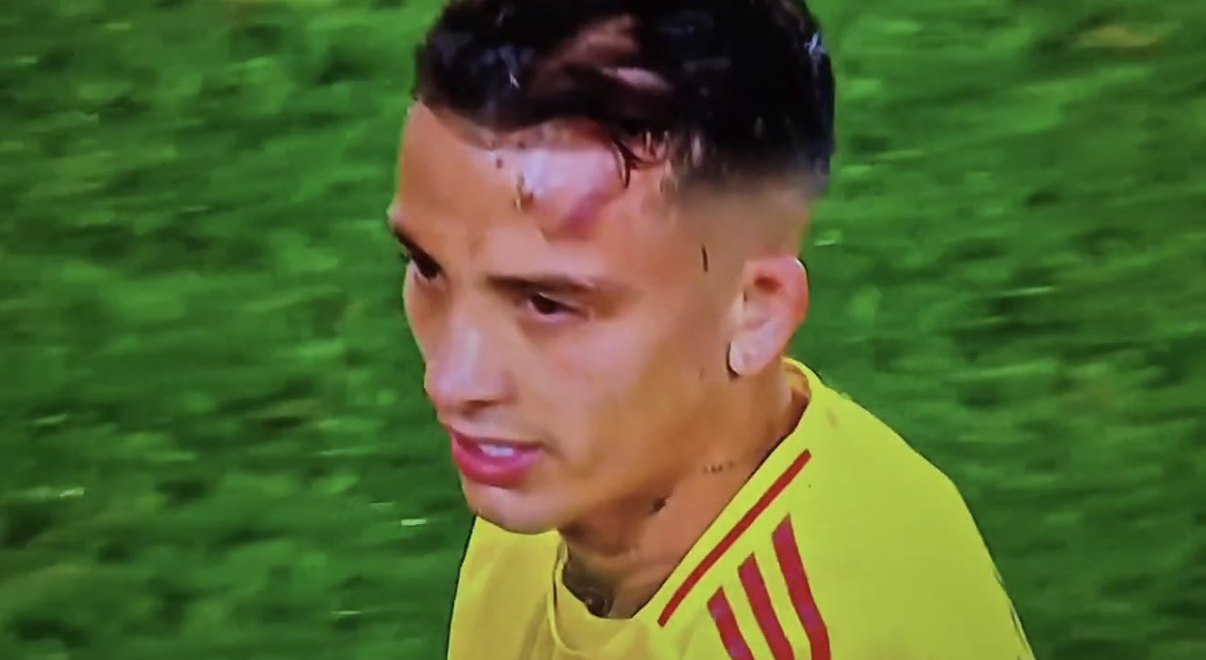 Así quedó la cara de Kevin Castaño tras la patada de Enzo Fernández.