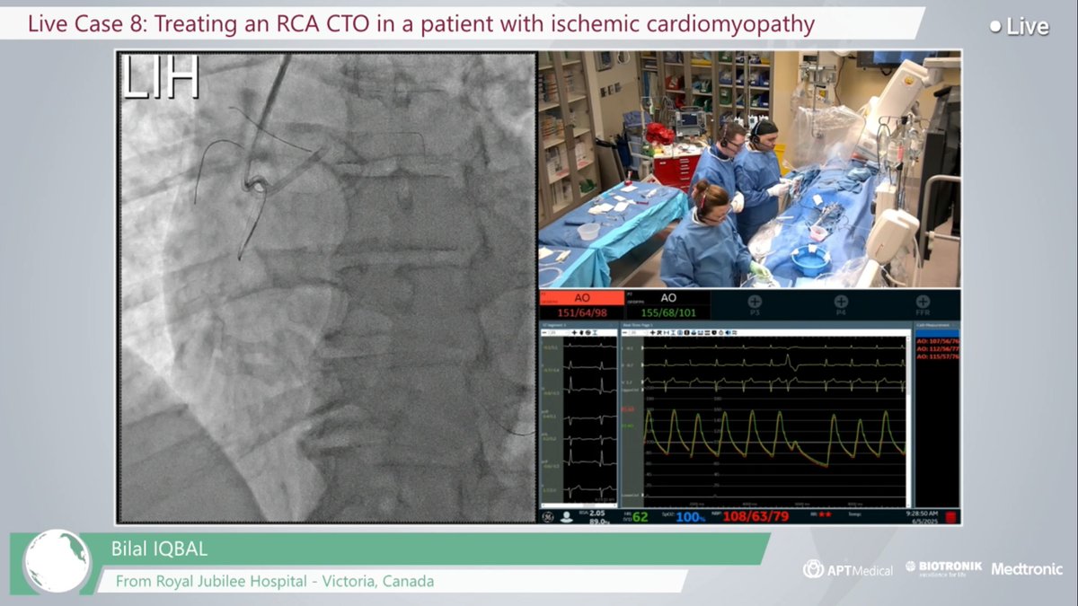 APTMedDevices's tweet image. 👏 Congrats to Dr. Bilal Iqbal from Canada on successfully completing a complex RCA CTO case during Live CTO Aid last week!
Our #AnyreachP™ 0.6g guidewire demonstrated excellent navigational performance.
Thanks to Dr. Iqbal for his expertise and trust!
#CardioTwitter