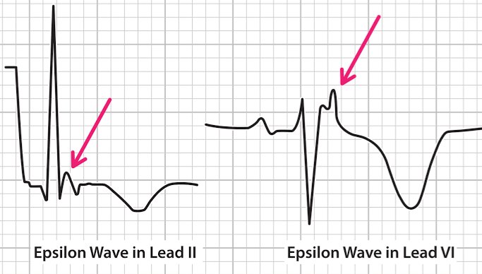 Arrhythmogenic right ventricular dysplasia / cardiomyopathy (ARVD/C).