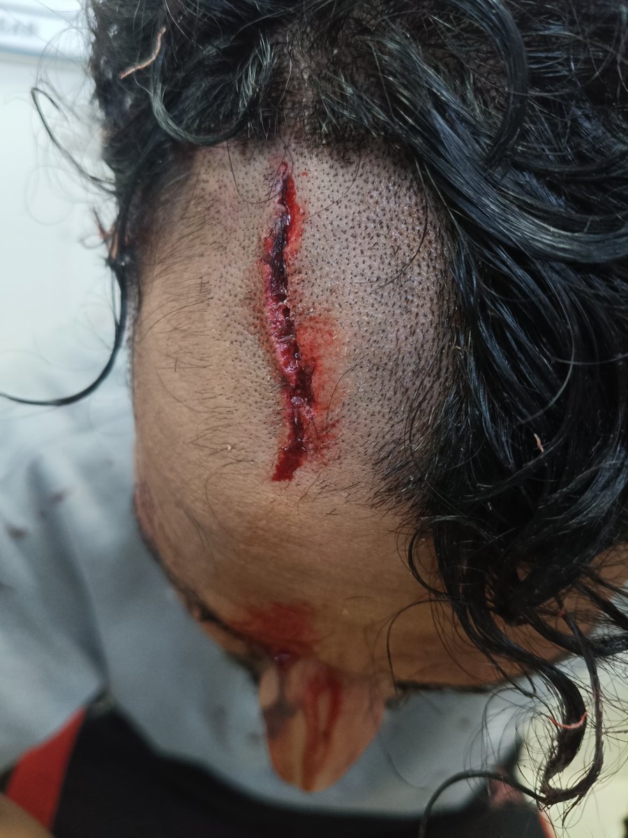 Soil_Ranger's tweet photo. Attempt to murder me (CHAKSHU, 2021A32BIV, ICAR admission) and my junior of 1st yr (DEEPANSHU KADYAN, 2021ABM04BIV) by CCSHAU AP Dr. Radhey Shyam, Sociology (COA, Bawal.
During a peaceful protest yesterday around 22:15 in HAU, Hisar.
@icarindia @DGPHaryana @Dattatreya @cmohry https://t.co/g9plY1o6Nz