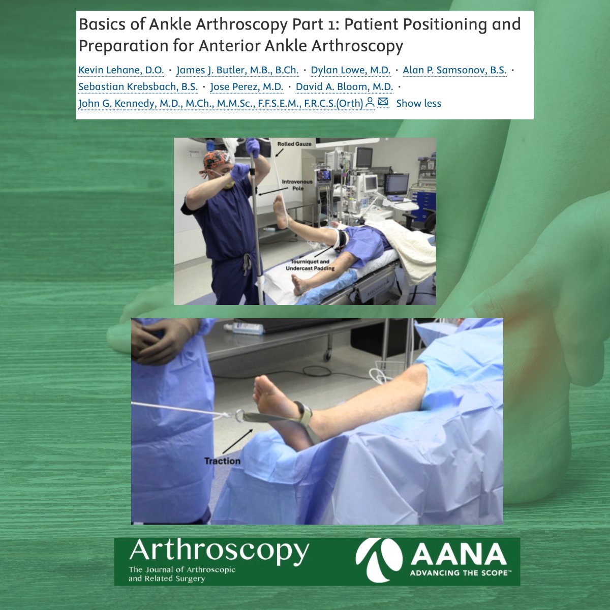 Arthroscopy Journal (@arthroscopyj) on Twitter photo Basics of Ankle Arthroscopy Part 1: Patient Positioning and Preparation for Anterior Ankle Arthroscopy
#AnkleArthroscopy #OrthopedicSurgery #SportsMedicine
<a href="/KevinLehaneJr/">Kevin Lehane, DO</a> <a href="/drjohnkennedy/">John G. Kennedy, MD, FRCS</a> <a href="/nyulangone/">NYU Langone Health</a>
ow.ly/hguX50W5Thm Basics of Ankle Arthroscopy Part 1: Patient Positioning and Preparation for Anterior Ankle Arthroscopy
#AnkleArthroscopy #OrthopedicSurgery #SportsMedicine
<a href="/KevinLehaneJr/">Kevin Lehane, DO</a> <a href="/drjohnkennedy/">John G. Kennedy, MD, FRCS</a> <a href="/nyulangone/">NYU Langone Health</a>
ow.ly/hguX50W5Thm