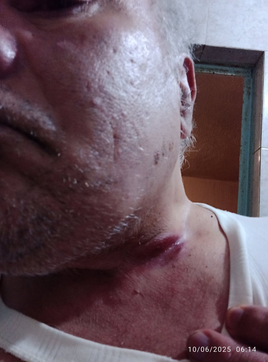 diep_flors's tweet photo. AYUDA Presidenta @Claudiashein @GobiernoMX @Defensamx1 anoche 10 d junio criminal electromagnético en tecnología del estado me quemo en mi cuello con energías dirigidas,ahorita me induce pesadillas #DirectedEnergyWeapons #Tortura  #TargetedIndividuals
#Amenazas

#GobiernoDeMéxico https://t.co/jZ08Fa24HL