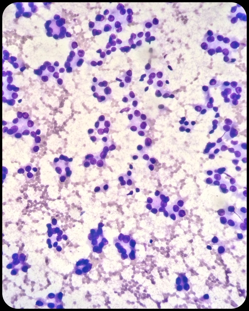 duckhuca's tweet photo. 💁🏽 Left thyroid nodule.
💉 Ultrasound guided fine needle aspiration performed by Interventional Pathologist.
2️⃣ Passes.
🔬 Bethesda IV.  Follicular neoplasm.

#CytoPath #Cytology #PathX #PathTwitter https://t.co/rEuWZqbW6j