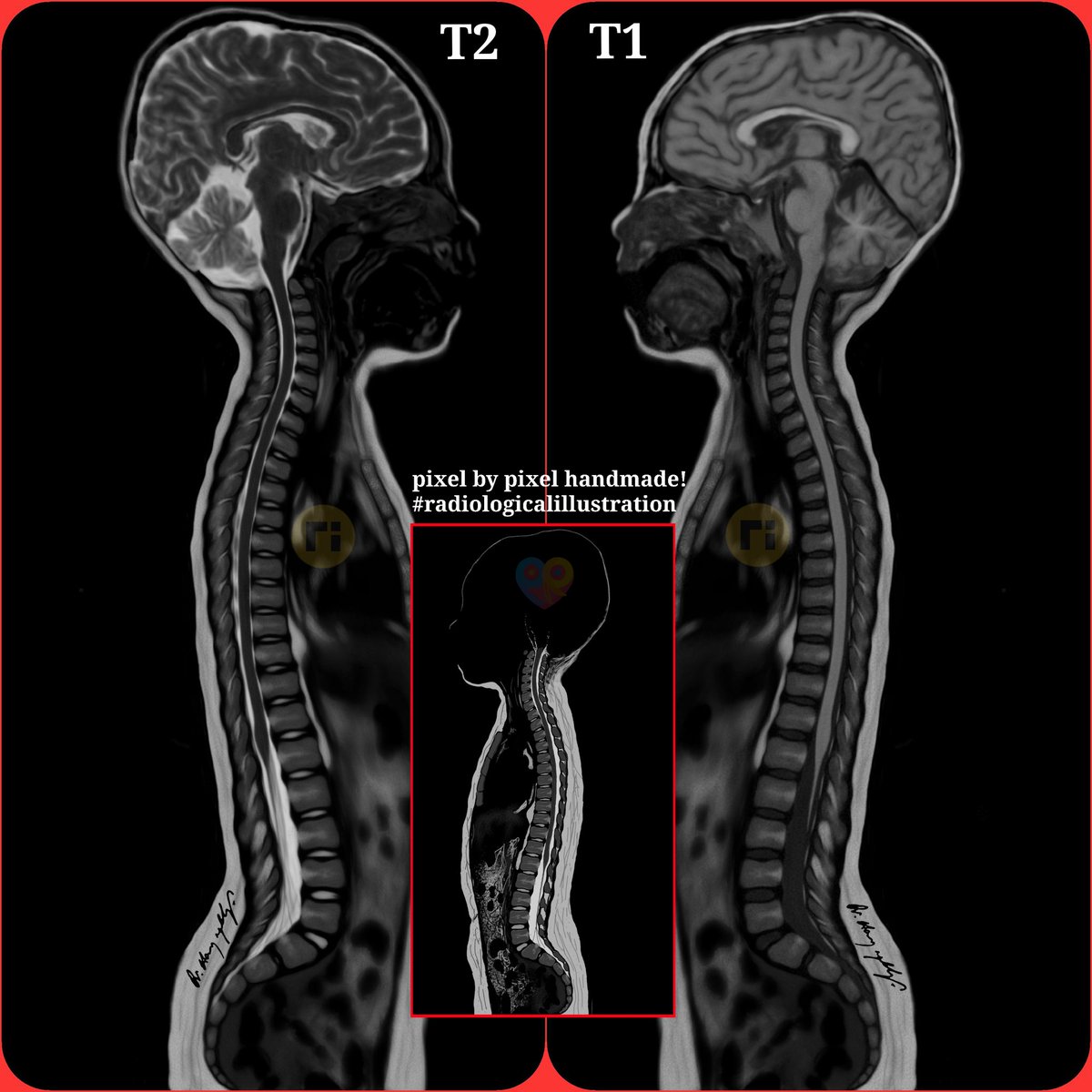 drharunyildiz's tweet image. ✍️✍️✍️
radiologicalillustration.com
pediatrikradyoloji.com
pixel by pixel handmade!
#radiologicalillustration