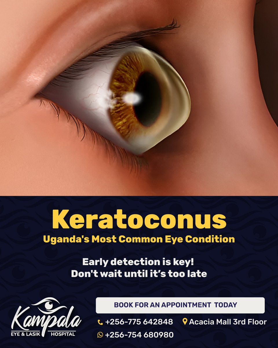 What is Keratoconus?
Keratoconus is a progressive eye condition where the cornea thins and bulges into a cone shape. 
It is the most commonly diagnosed eye condition in Uganda, yet it often goes unnoticed because its symptoms can seem mild or general at first.

Why Should You Be