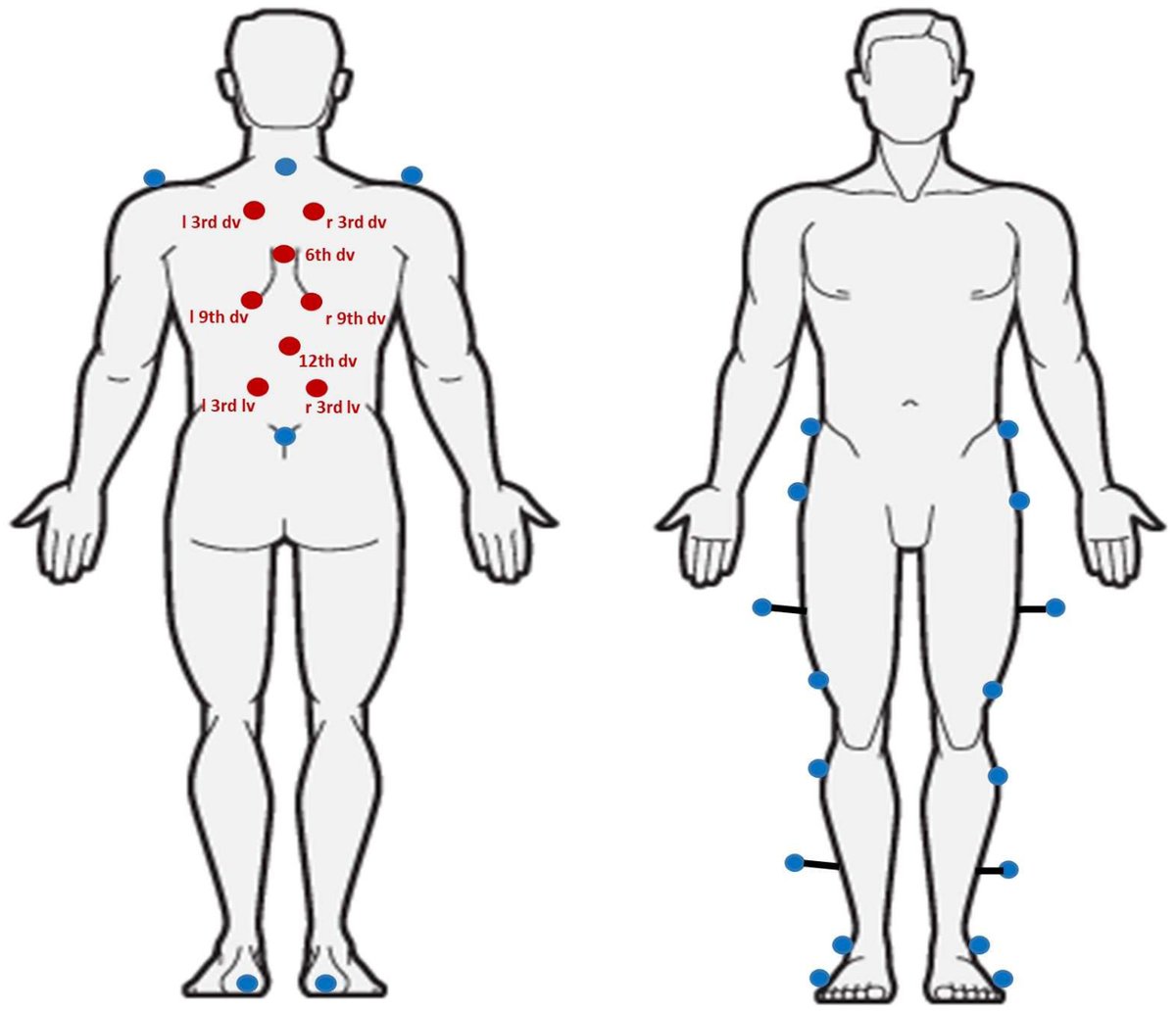 This study introduced a new protocol for the integrated assessment of gait and spinal movements during gait, in order to produce a global analysis of spinal and multi-segmental body kinematics. Link: lnkd.in/dsJcdJsF

#spine #gait #thoracicspine #lumbar #kinematic  #motion
