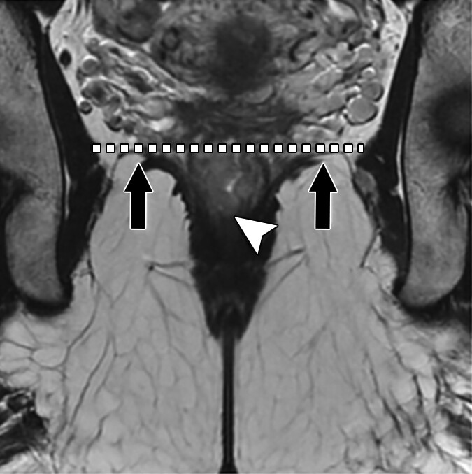 This AJR Expert Panel Narrative Review addresses recent advances and key areas of contention in rectal cancer MRI.

ajronline.org/doi/10.2214/AJ…