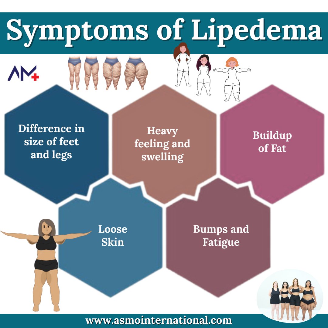 ashimamunjal05's tweet photo. Symptoms of Lipedema
.
https://t.co/9yLJI3L2y1
.
#Lipedema #LipedemaAwareness #LipedemaSymptoms #ChronicPain #FatDisorder #SwollenLegs #LegPain #LymphaticHealth #BodyPainAwareness #WomenWithLipedema #asmointernational #asmohealth #asmomedicines #asmocare #asmoresearch #asmo https://t.co/Z1FpnsfGLc