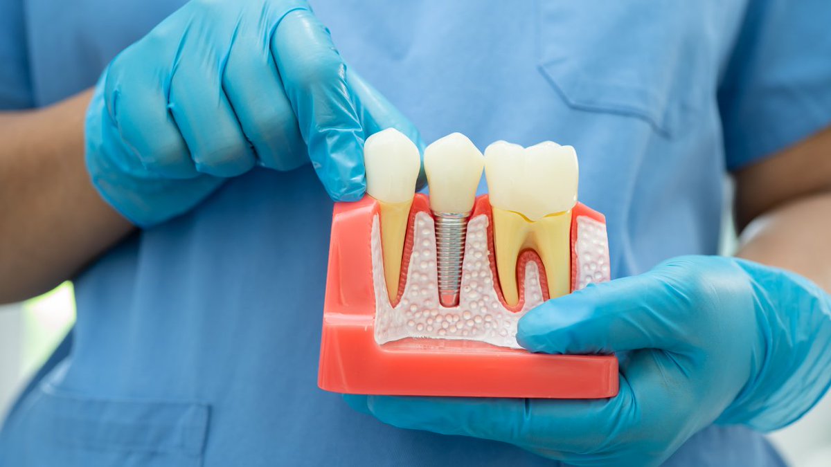 3 things a patient must know after root canal treatment (RCT) is done

Get the most useful tips at MedBound HUB: 
medboundhub.com/t/3-things-a-p…

#RootCanal #NEETPG #NEETUG #RCT #Patients #MedBoundHUB