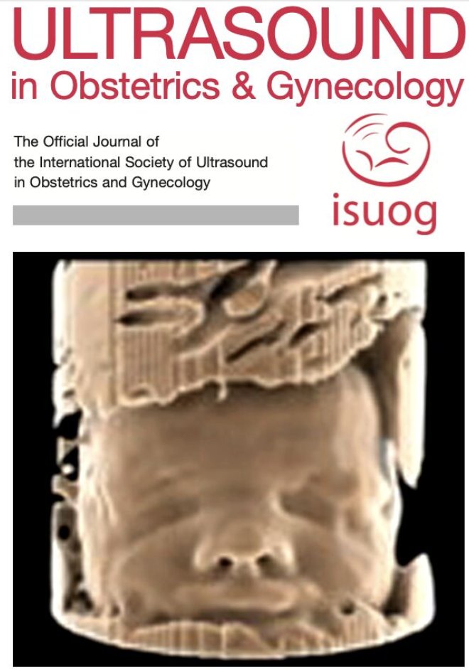 Decision and Bayesian Computation (@decbaycomp) on Twitter photo Our first paper with Fondation LUMIERE on Photorealistic rendering of fetal faces from raw MRI
Thomas Blanc charlotte godard <a href="/MoElbeheiry/">Mohamed El Beheiry</a> @bassamhajj David Grévent Laurent SALOMON <a href="/Bassam_A_HAJJ/">Bassam HAJJ</a>
<a href="/institutpasteur/">Institut Pasteur, since 1887</a> <a href="/Inria/">Inria</a> <a href="/InstitutImagine/">Institut Imagine</a> <a href="/CNRS/">CNRS 🌍</a> <a href="/universiteparis/">Université de Paris</a> Our first paper with Fondation LUMIERE on Photorealistic rendering of fetal faces from raw MRI
Thomas Blanc charlotte godard <a href="/MoElbeheiry/">Mohamed El Beheiry</a> @bassamhajj David Grévent Laurent SALOMON <a href="/Bassam_A_HAJJ/">Bassam HAJJ</a>
<a href="/institutpasteur/">Institut Pasteur, since 1887</a> <a href="/Inria/">Inria</a> <a href="/InstitutImagine/">Institut Imagine</a> <a href="/CNRS/">CNRS 🌍</a> <a href="/universiteparis/">Université de Paris</a>