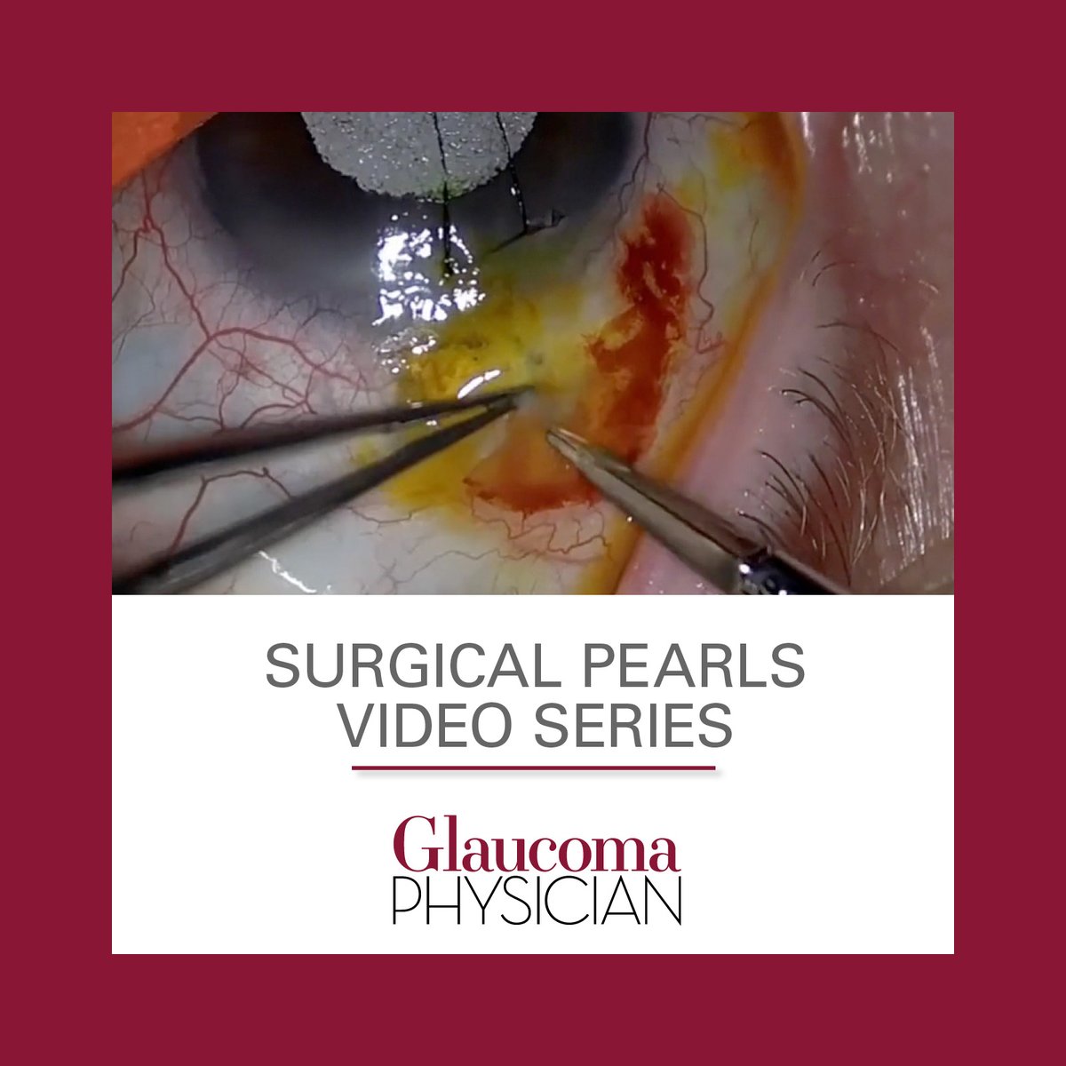 In this month’s Surgical Pearls video, Huda Sheheitli, MD, presents a technique for surgical revision of an exposed Baerveldt tube shunt associated with scleral melt. View here: ow.ly/fJj250W6yPB
#GlaucomaPhysician #GPnews #SurgicalPearls #Conexiant