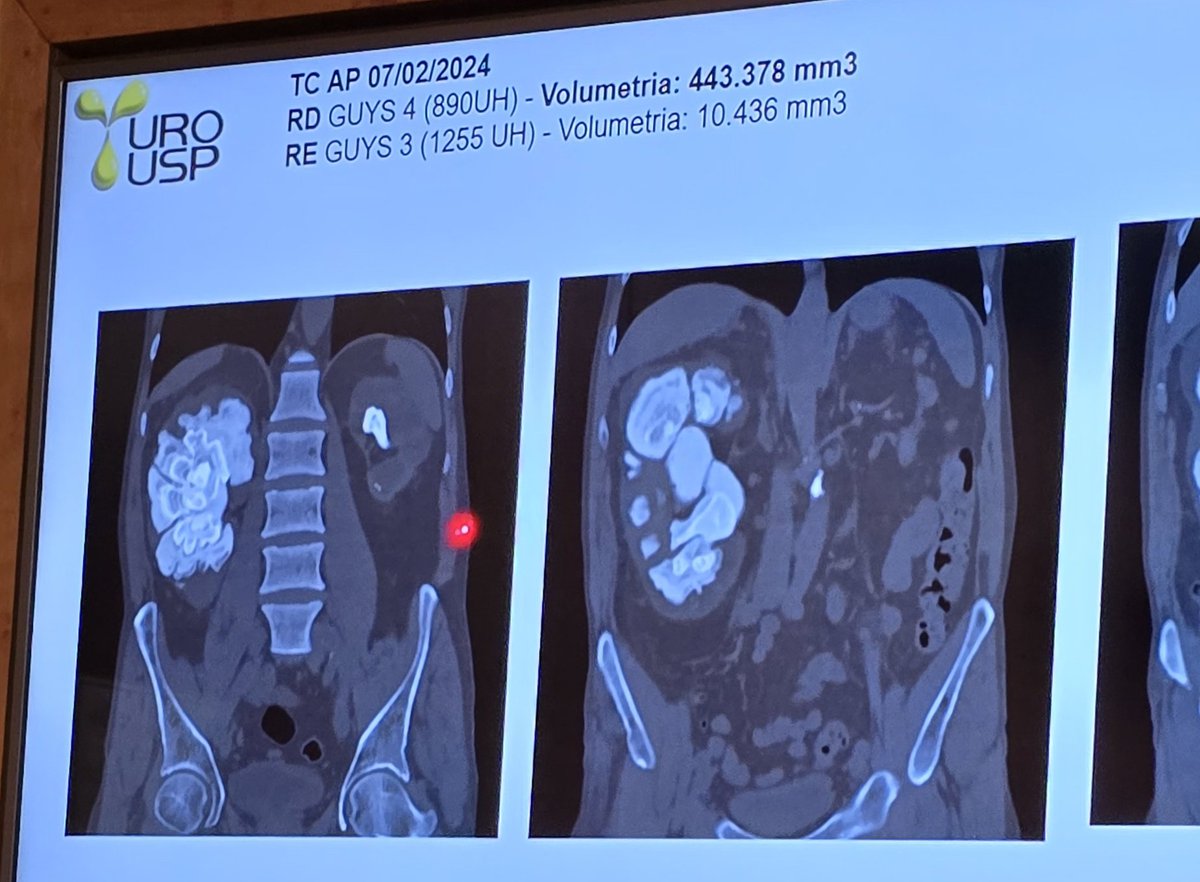VicentiniUro's tweet photo. 443.378 mm³ of stone burden on the right kidney! Does anyone have a case with more stones?  @Endo_Society @sbuoficial @Uroweb @CAU_URO @AmerUrological https://t.co/dLnfeqhj1M
