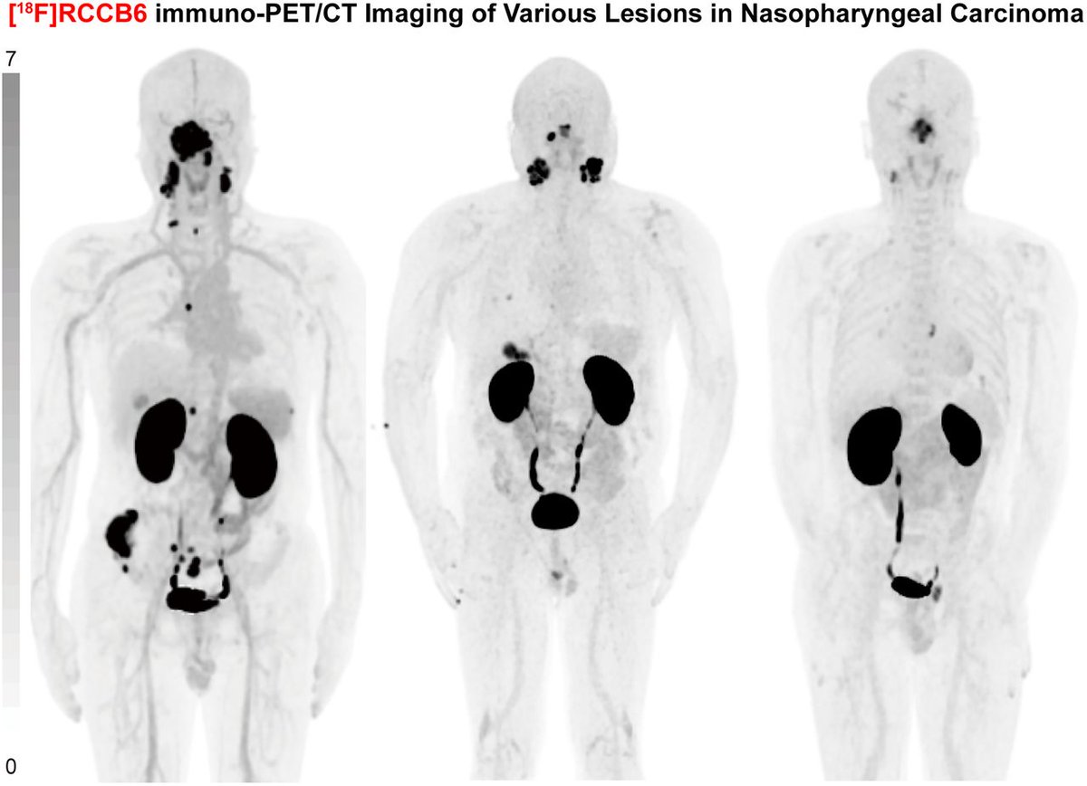 SNM_MI's tweet image. A new immuno-PET/CT   imaging technique has identified and validated the biomarker CD70, which is highly and constantly expressed in nasopharyngeal cancer (NPC). jnm.snmjournals.org/content/66/6/8…