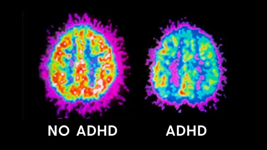 Vikram (@vikrammjha) on Twitter photo You’ve been lied to.
ADHD isn’t a mental disease that needs to be “fixed.”
It’s a different kind of brain...
built for creativity, energy, and hyperfocus.
Here’s how you turn ADHD into productivity (backed by science): You’ve been lied to.
ADHD isn’t a mental disease that needs to be “fixed.”
It’s a different kind of brain...
built for creativity, energy, and hyperfocus.
Here’s how you turn ADHD into productivity (backed by science):