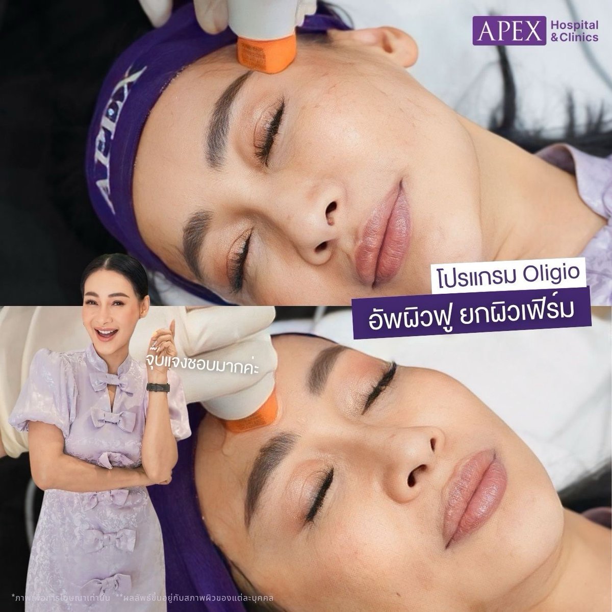Apex Beauty Clinic tweet media