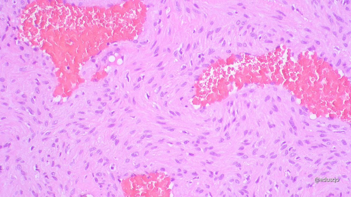 Angioleiomyoma, cavernous type:
▫️Benign, painful (50%), solitary
▫️Well circumscribed/encapsulated
▫️Dilated vascular channels whose walls are difficult to distinguish from the intervascular smooth muscle
▫️"Staghorn" vessels
▫️DDx myopericytoma, cavernous hemangioma...
#BSTPath