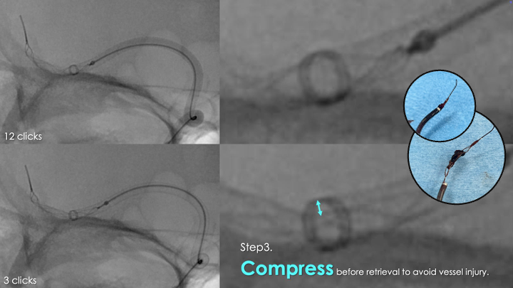 The “Dual Bite Pass,” pioneered by Dr. Daisuke Watanabe, combines TIGERTRIEVER™’s active technology with the suction of aspiration to enhance optimal clot integration and retrieval. 💡 

Thanks for sharing, Dr. Watanabe.