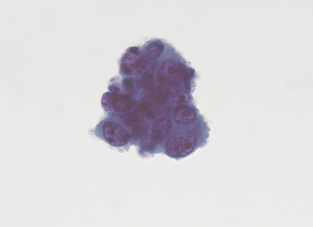 Just a great example - Cervical PAP test in a patient with history of “Colorectal Adenocarcinoma”. Complete LACK of background tumor diathesis is consistent with metastasis from the patient’s known primary over local invasion or a new gynecological primary. (SurePath)