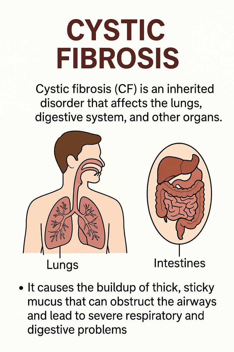 RespiratoryZone's tweet image. Cystic fibrosis is a genetic disorder that affects the exocrine glands, causing thick, sticky mucus to build up in the lungs, digestive tract, and other organs, leading to respiratory and digestive problems.