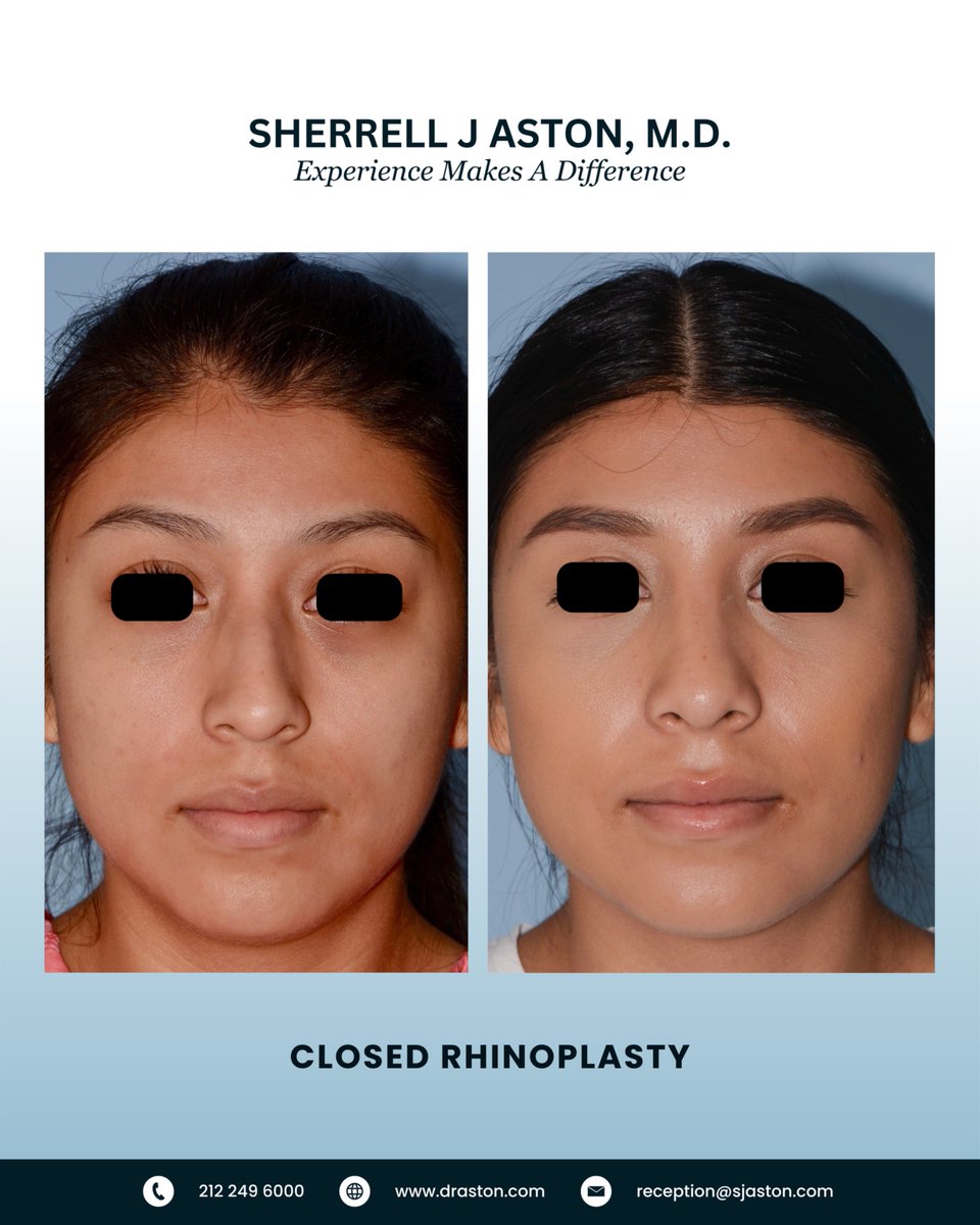 Closed Rhinoplasty (no scars) creating a nose that is a perfect shape and size for the patient’s face. The patient loves the result – and so do we!!

#closedrhinoplastyspecialist #scarlessrhinoplasty #nosebyaston #topplasticsurgeonsinamerica #bestplasticsurgeonsinamerica