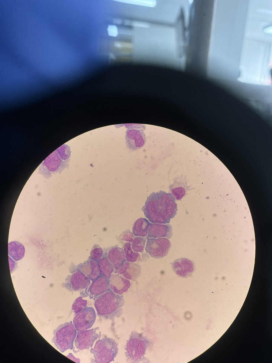 SantiagoFS_'s tweet photo. When your CSF looks more like bone marrow… 😩💔 https://t.co/0eE86MpPWJ