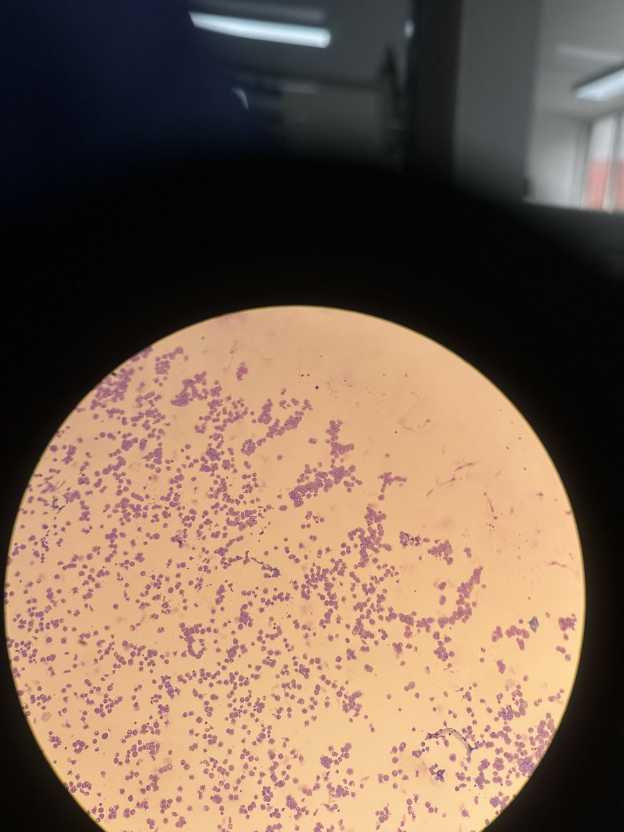 SantiagoFS_'s tweet photo. When your CSF looks more like bone marrow… 😩💔 https://t.co/0eE86MpPWJ
