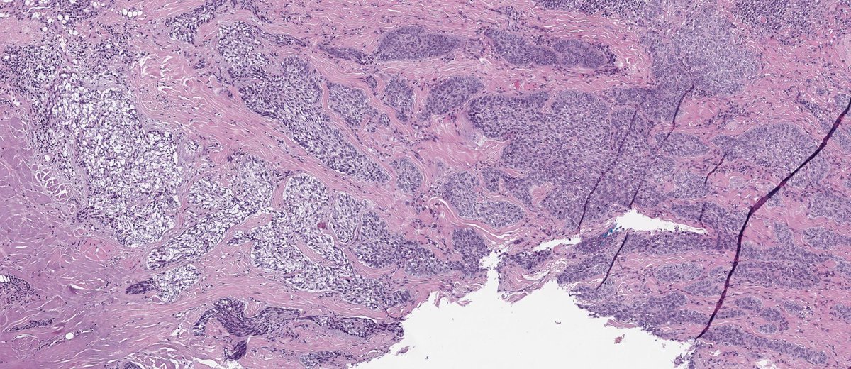 Clear cell changes in BCC isn’t routine—but it’s not rare either
#dermpath #PathTwitter #dermtwitter