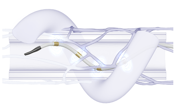 CathLabDigest's tweet image. Medtronic Treats First U.S. Pt in Global SYMPLICITY Registry DEFINE Study
Large, international registry expands real-world data for Symplicity BP procedure for uncontrolled hypertension
Read more from the CLD Renal Denervation Topic Center:
hubs.ly/Q03rJp250
#cardiotwitter