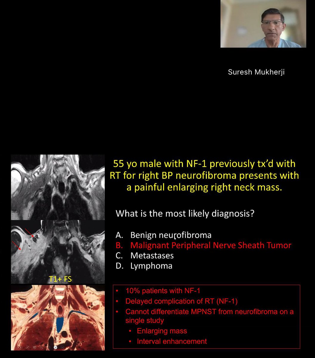 Dr Aanchal Agarwal (@aanch09) on Twitter photo Outstanding presentation on brachial plexus by <a href="/sureshmukherji/">Suresh Mukherji</a>.
Simplified version of this complex neural highway that everyone tries to ignore be it Friday arvo or Monday morning.Hopefully no more!
Thank you so much <a href="/J_McCloskeyMD/">Justin McCloskey, MD</a> and <a href="/thecortexclub/">The Cortex Club</a> for putting this together. Outstanding presentation on brachial plexus by <a href="/sureshmukherji/">Suresh Mukherji</a>.
Simplified version of this complex neural highway that everyone tries to ignore be it Friday arvo or Monday morning.Hopefully no more!
Thank you so much <a href="/J_McCloskeyMD/">Justin McCloskey, MD</a> and <a href="/thecortexclub/">The Cortex Club</a> for putting this together.