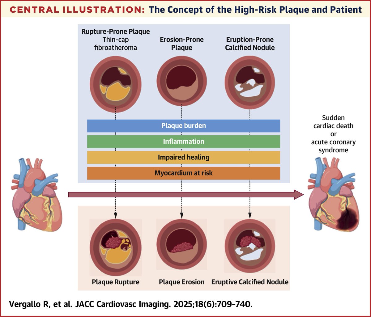 JACC Journals (@jaccjournals) on Twitter photo "High-risk plaque,” not “vulnerable plaque”? This new #JACCIMG statement explores challenges to the concept, advances in imaging & therapy, and the future of focal interventions. jacc.org/doi/10.1016/j.…
<a href="/ron_waksman/">Ron Waksman</a> <a href="/GreggWStone/">Gregg W. Stone MD</a> <a href="/RoccoVergallo/">Rocco Vergallo</a> "High-risk plaque,” not “vulnerable plaque”? This new #JACCIMG statement explores challenges to the concept, advances in imaging & therapy, and the future of focal interventions. jacc.org/doi/10.1016/j.…
<a href="/ron_waksman/">Ron Waksman</a> <a href="/GreggWStone/">Gregg W. Stone MD</a> <a href="/RoccoVergallo/">Rocco Vergallo</a>